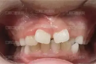 【正畸科普】听专家说整牙那回事儿（十六）——替牙期间隙管理